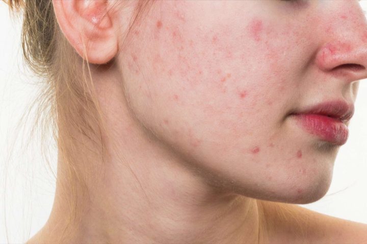 L'acné : quelle prise en charge en 2018 - EvalFormSanté